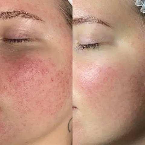 Scar and Spot Treatments